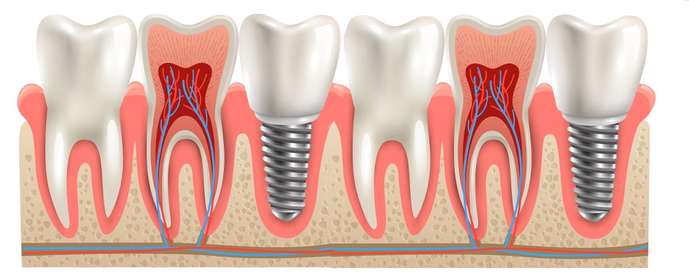 ایمپلنت دندان چیست؟