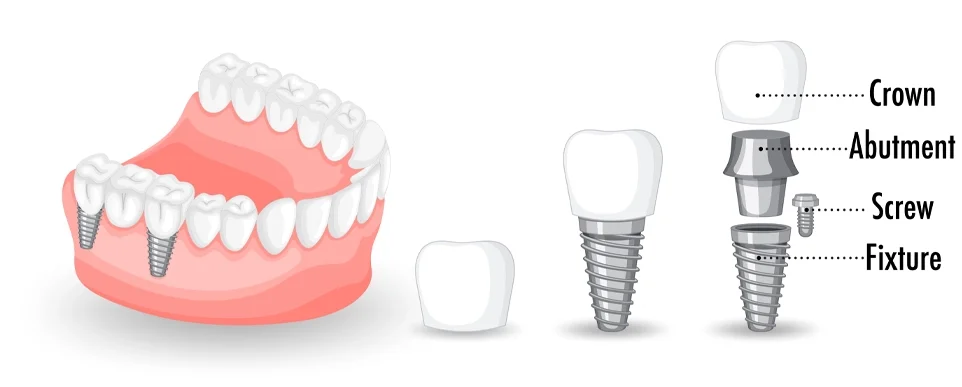 ایمپلنت دندان چیست و چگونه کار می‌کند؟
