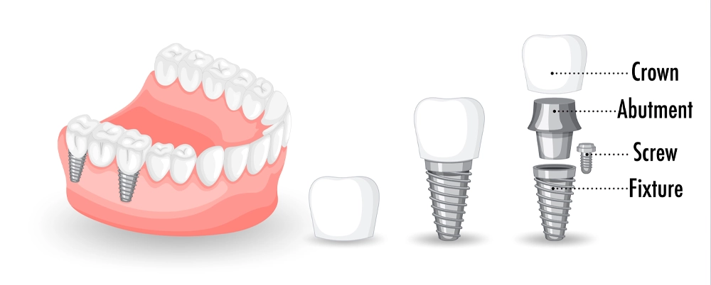 ایمپلنت دندان چیست و چگونه کار می‌کند؟