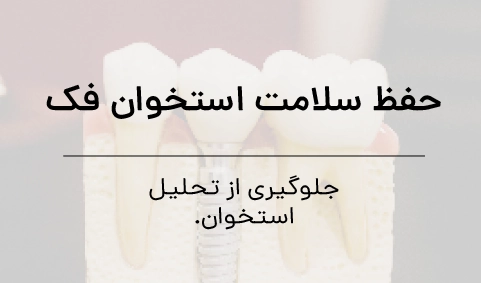 عرفان صفری ایمپلنت